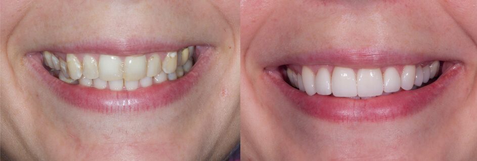 before and after veneers and a crown in our smile gallery in Stuart, FL