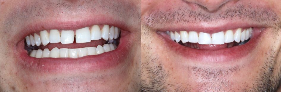 Before and after bonding on front teeth in our smile gallery in Stuart, FL