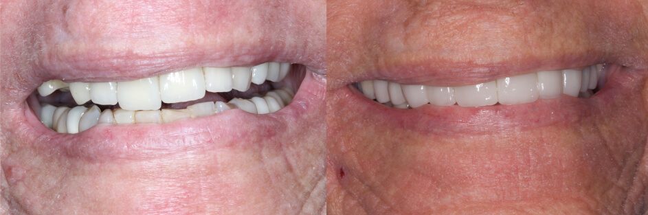 before and after broken tooth restoration in our smile gallery in Stuart, FL