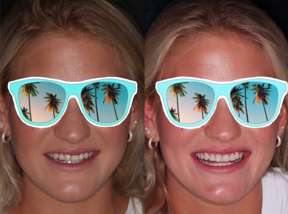 Before and after composite veneers in Stuart, FL