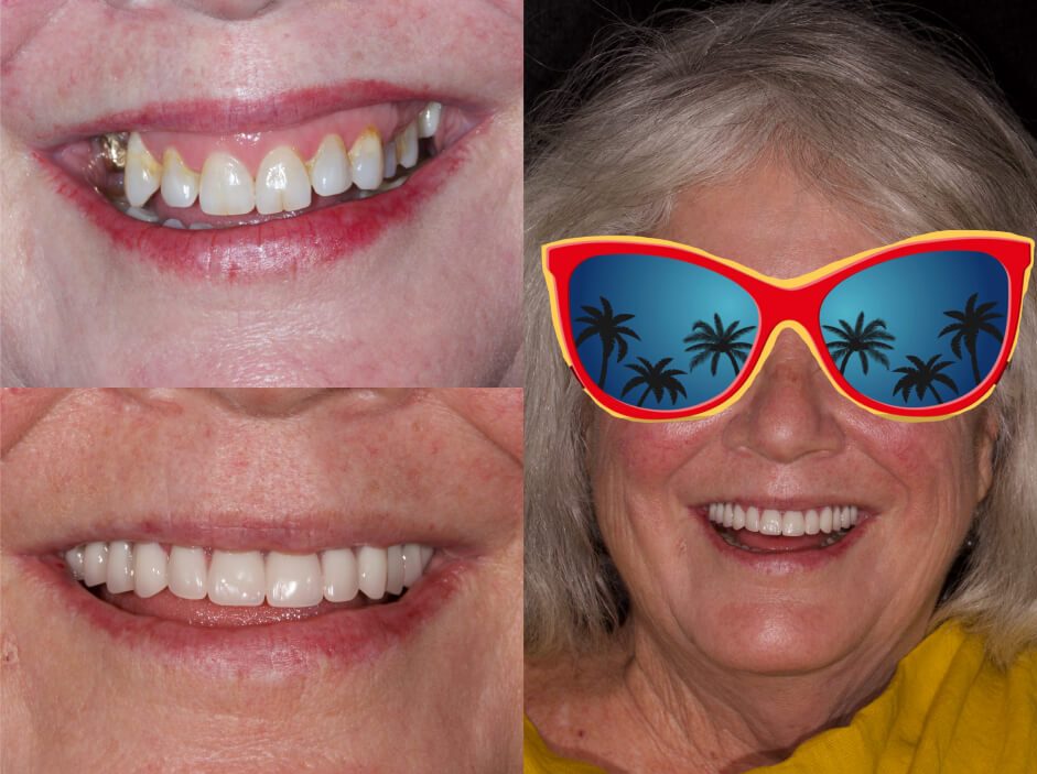 Dental implants and a permanent implant-supported denture in our smile gallery in Stuart, FL