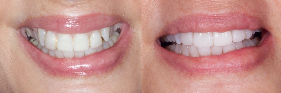 Before and after veneers on the front teeth in smile gallery in Stuart, FL