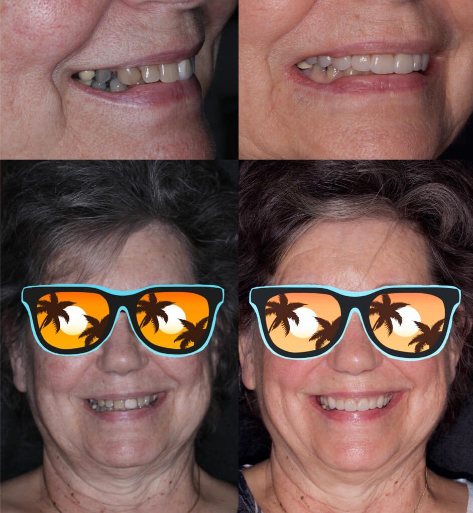 before and after crowns and veneers in our smile gallery Stuart, FL