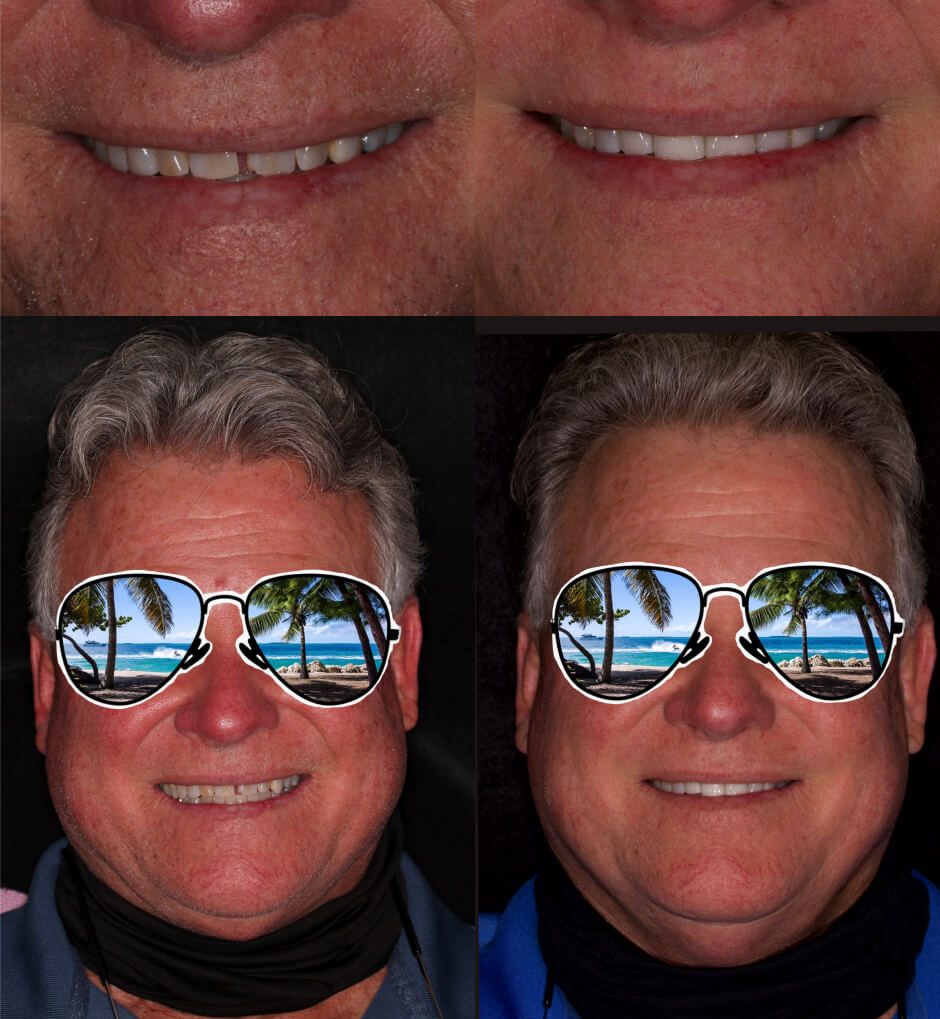 before and after veneers and crowns in our smile gallery in Stuart, FL