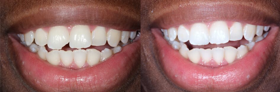 before and after color-matched tooth bonding in Stuart, FL