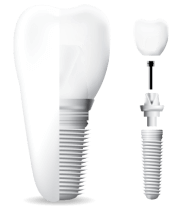 dental implant fixture including a crown, abutment, and post